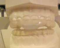 Anti snoring in hendon london, mouth guard for sleeping